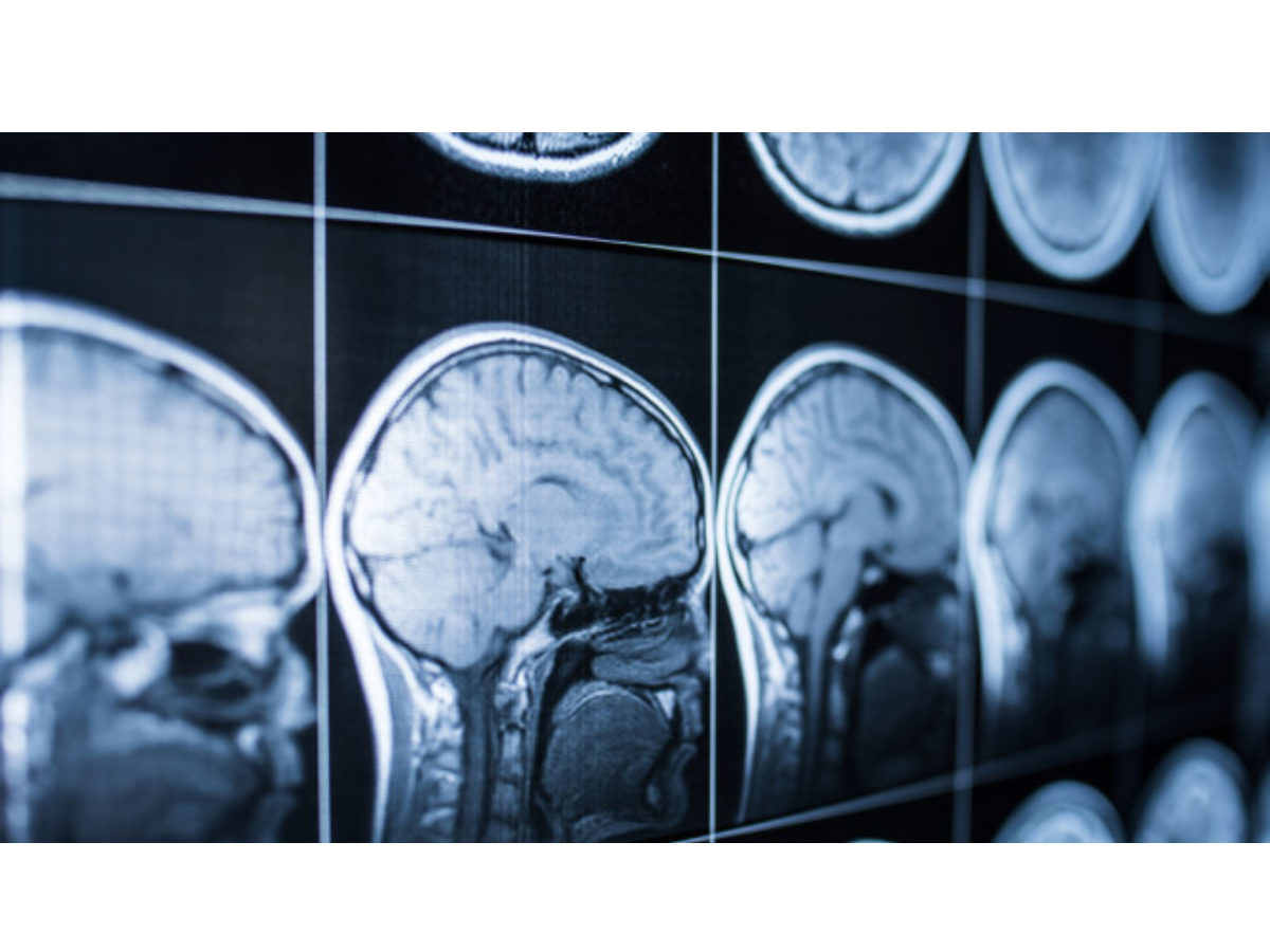 How Your Brain’s “Fingerprints” Could Diagnose Disease