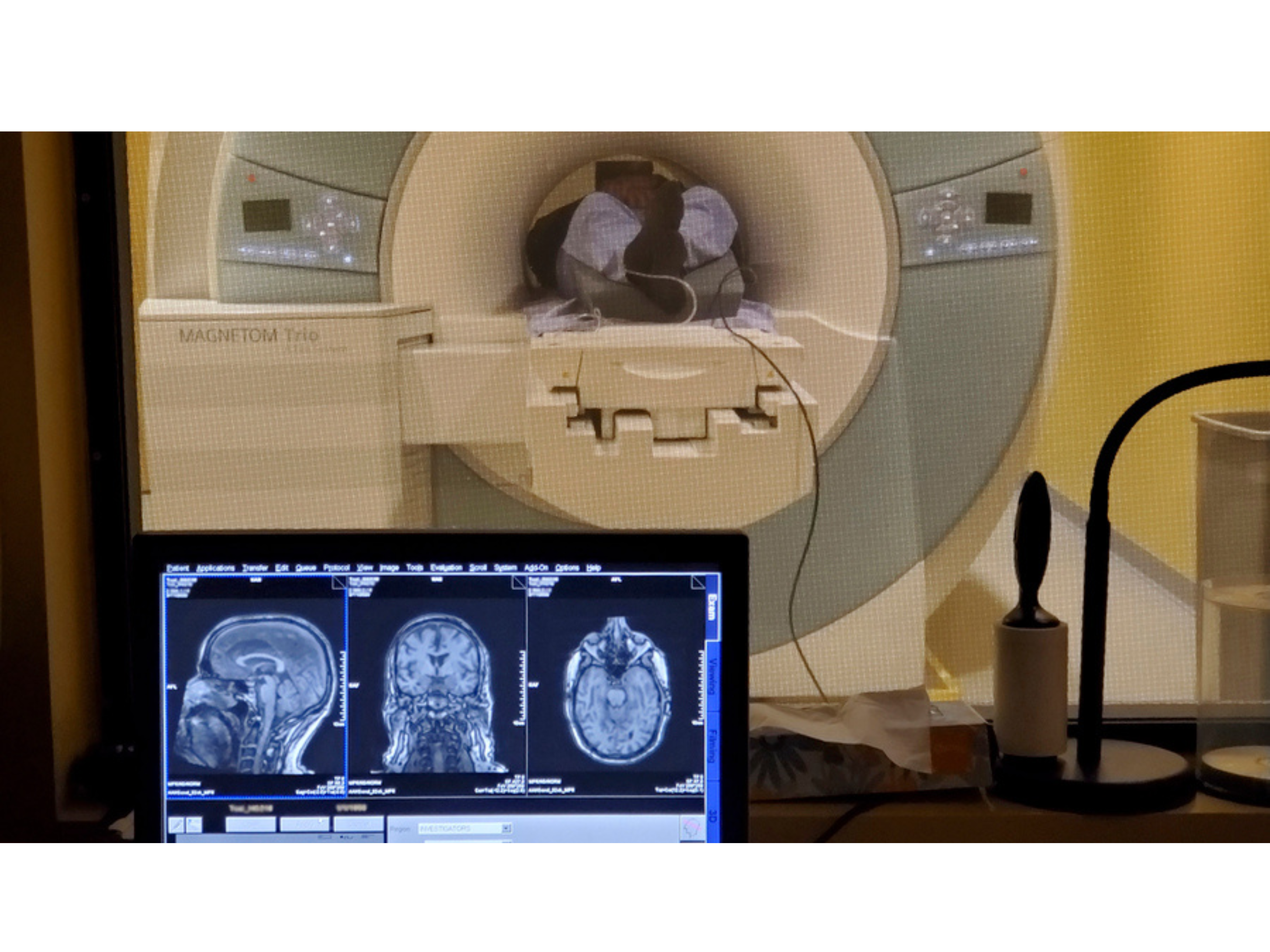 Small studies of 40-hertz sensory stimulation confirm safety, suggest Alzheimer’s benefits