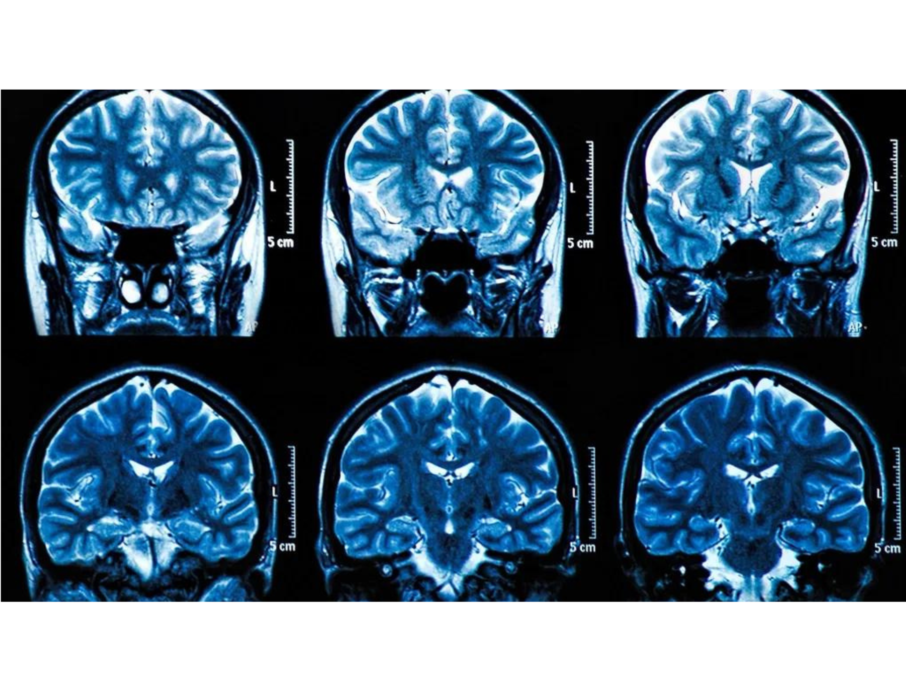 Breakthrough Test for Alzheimer’s: New Biomarker Can Detect Neurodegeneration in Blood